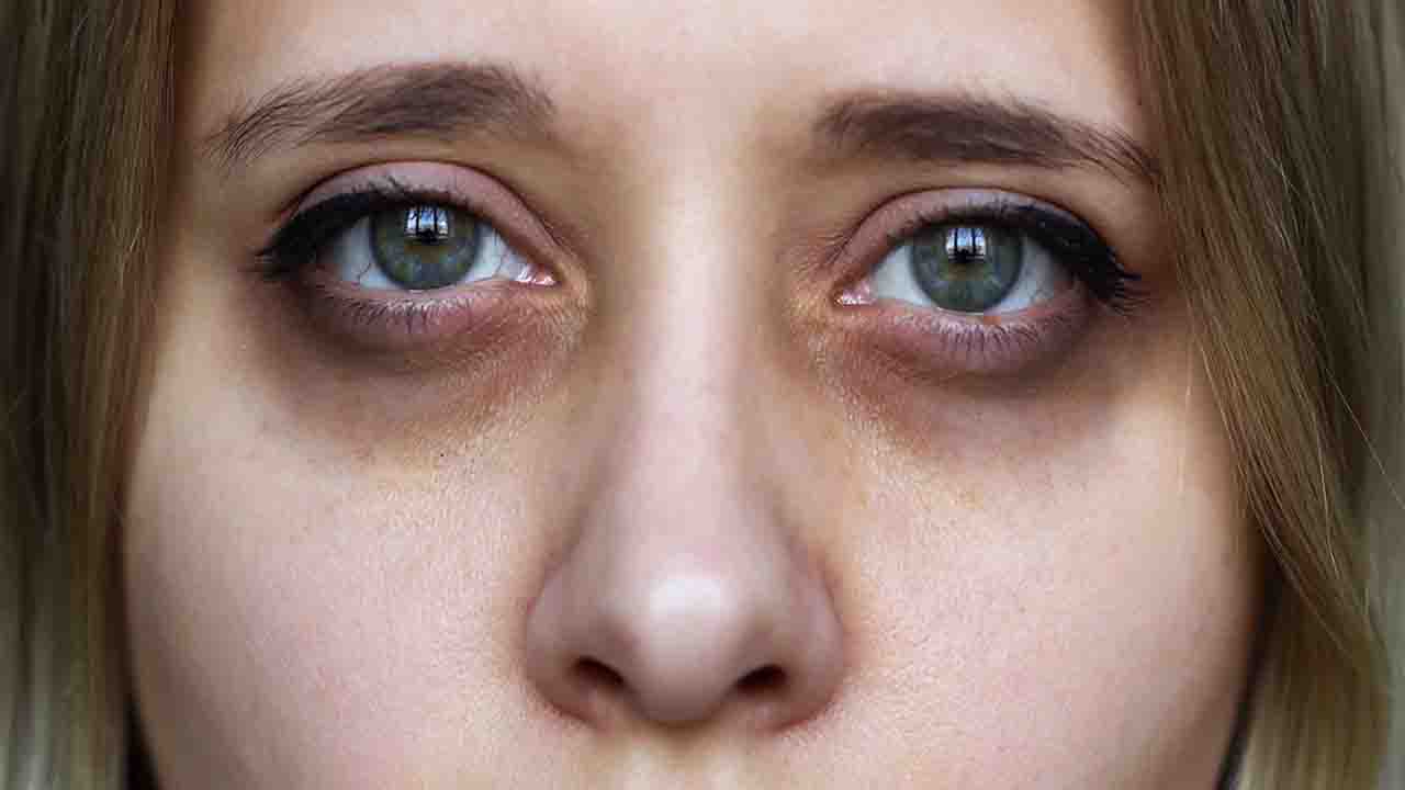 Dark Circles: Causes and Effective Home Remedies